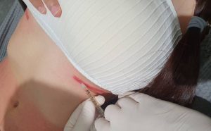 Bangkok Dermatologists Use Patients Own Blood Cells to Accelerate Laser Scar